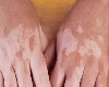 World Vitiligo Day 2024: શા માટે હોય છે સફેદ ડાઘ, જાણો શરૂઆતી લક્ષણ અને સારવાર