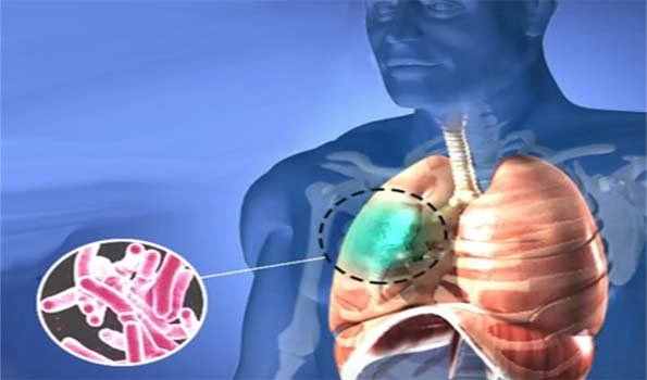 Tuberculosis: First time infections rise to 30-year high