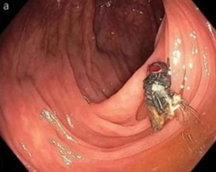 Fly found living inside 63-yr-old's intestines during routine medical check