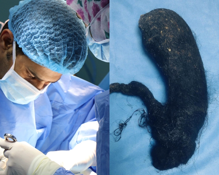 In complex surgery, 1.5 kg of human hair removed from teen-aged girl's stomach - WATCH