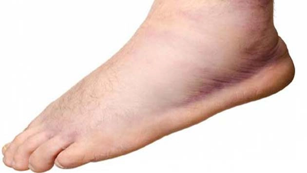 Swelling on feetपायांवर सुज येण्याचे मुख्य कारण जाणून घ्या