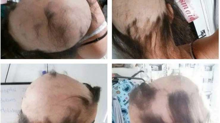 ब्रेकअप के बाद झड़ गए सारे बाल, फिर हुआ चमत्कार - her ‘toxic’ relationship gave her alopecia