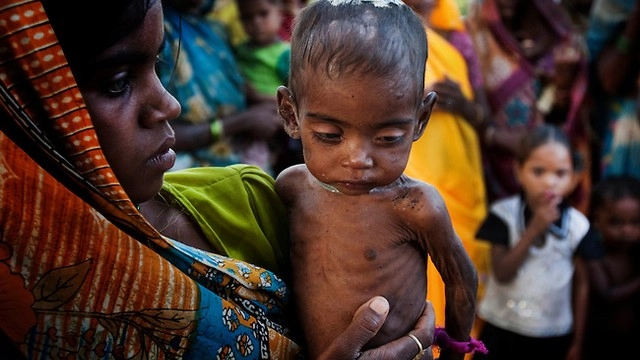मध्य प्रदेश में कुपोषण से हर दिन 92 बच्चों की मौत - in MP malnutrition kills 92 kids each day