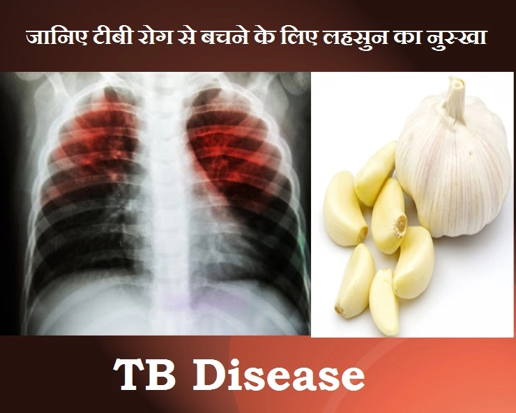 जानिए क्या है टीबी रोग और इससे बचने के लिए लहसुन का नुस्खा