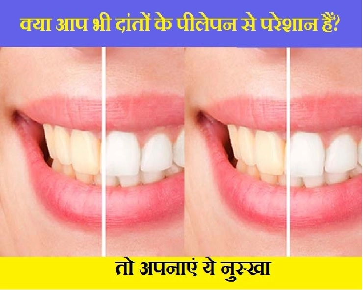 Dental Care Tips: दांतों के पीलेपन से पाएं छुटकारा, अपनाएं ये आसान टिप्स