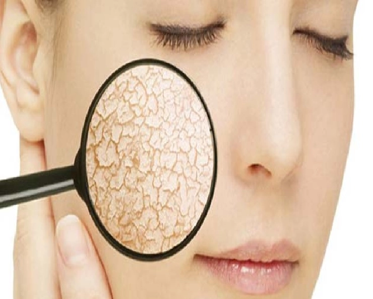 Beauty Care : जानिए Dry Skin के लक्षण और कारण - Dry Skin