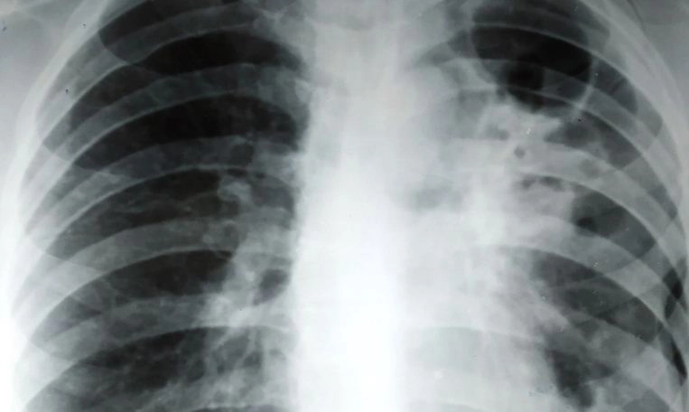 Covid-19  के बाद बढ़ रहे टीबी के मरीज, जानें क्‍या है यह बीमारी, लक्षण और उपचार