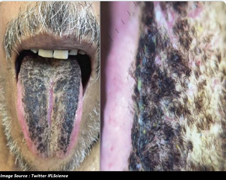 Black Hairy Tongue Syndrome : अमेरिकी शख्‍स की जीभ पर उगे बाल, जानें क्‍या हैं कारण और लक्षण