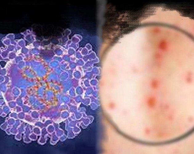 मंकीपॉक्स को रोकने के लिए स्मॉलपॉक्स की वैक्सीन को मंजूरी - Smallpox vaccine approved to prevent monkeypox