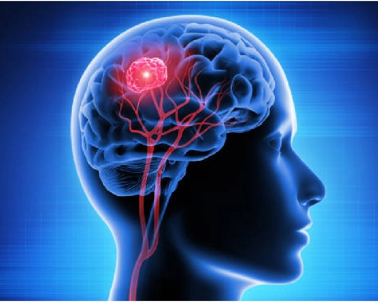 भारत में हर 4 मिनट में एक जान ले रहा Brain stroke, जानें इस बीमारी के लक्षण