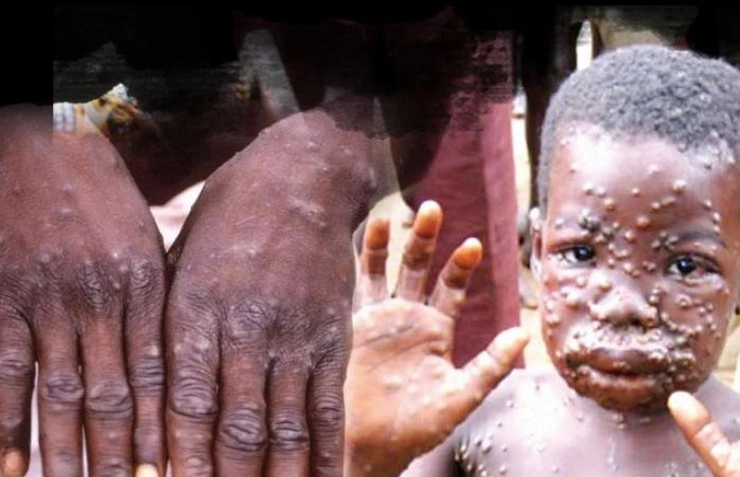 Monkeypox को WHO ने घोषित किया वैश्विक स्वास्थ्य आपातकाल, जानिए क्या हैं इसके मायने... - Monkeypox declared by WHO as a global health emergency, Know what it means