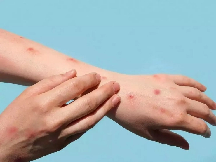 मंकीपॉक्स या त्वचा की एलर्जी: लोगों में दहशत, जांच के लिए बड़ी संख्‍या में पहुंच रहे हैं अस्पताल
