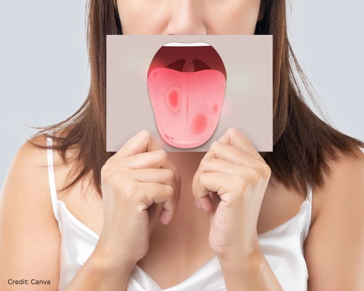 diseases related to tongue