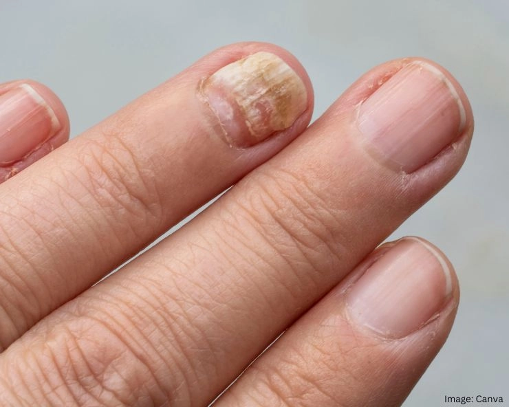 Skin Peeling Near Nails