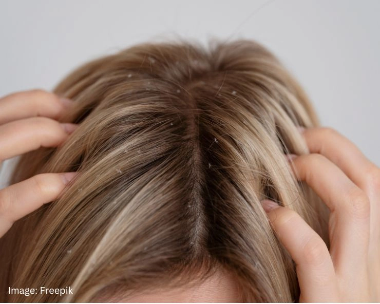 Home Remedies for Removing Lice