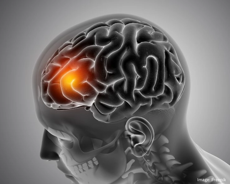 Brain Hemorrhage Symptoms