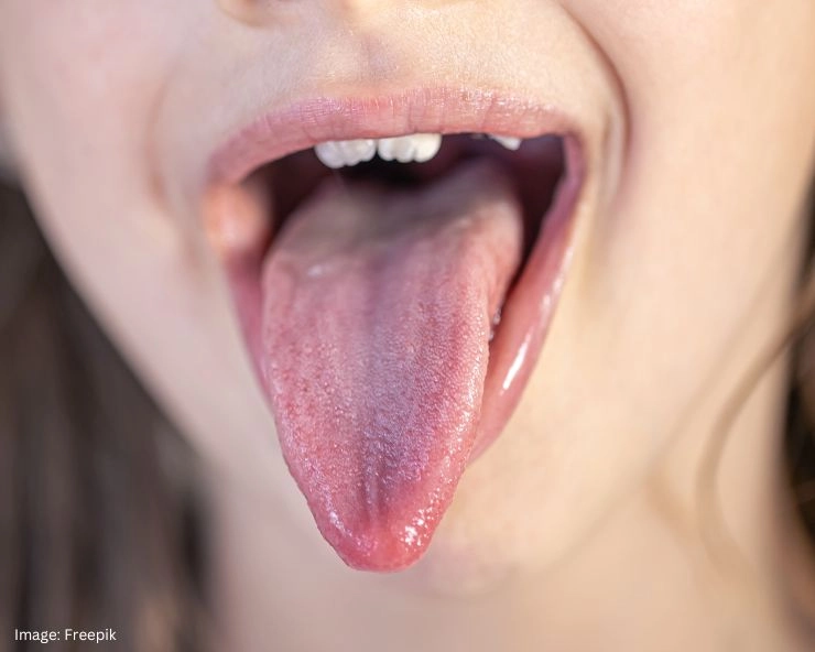 Tongue Signs Of Health Problems