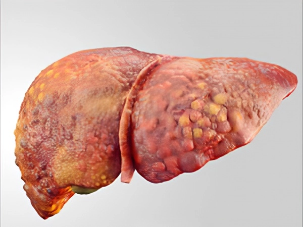 Liver cancer: ഈ അഞ്ചുശീലങ്ങള്‍ നിങ്ങള്‍ക്ക് ലിവര്‍ കാന്‍സര്‍ ഉണ്ടാകാനുള്ള സാധ്യത കൂട്ടും