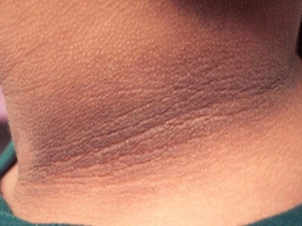 Black Colour in Neck, What is Acanthosis Nigricans, Dark Patch in neck, diabetes, Fat, Health News, Webdunia Malayalam 