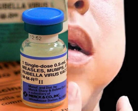 Mumps Outbreak,Mumps in kerala