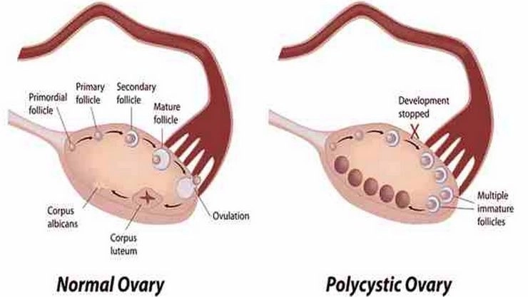 Poly Cystic Ovary