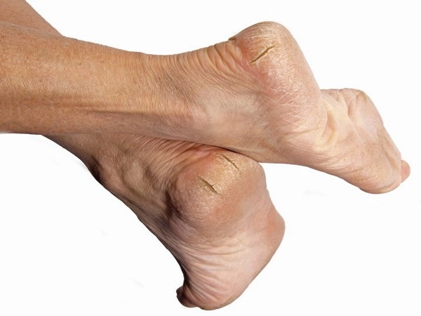 foot crack