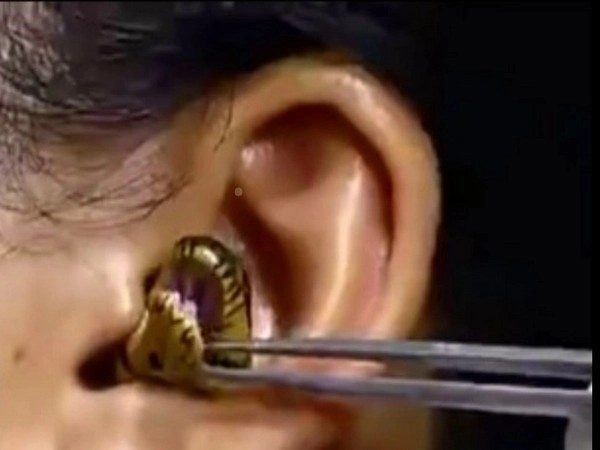 Snake in ear