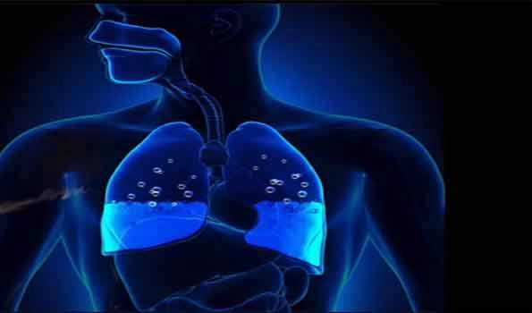 Pneumonia, a form of acute respiratory infection that affects lungs