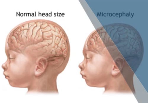 Microcephaly, a disorder that causes a baby's head to be small and not fully developed
