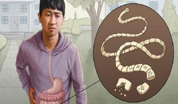 Taeniasis, an intestinal infection caused by 3 species of tapeworms