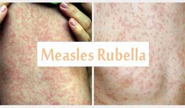 Zimbabwe: Measles outbreak leaves more than 150 children dead