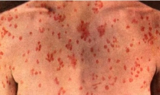 Albania mounts rapid response to measles outbreak