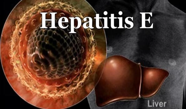 Hepatitis E, a liver disease caused by infection with a virus known as hepatitis E virus