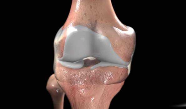 Osteoarthritis, a long-term chronic disease affects joints in knees, hands, feet, and spine