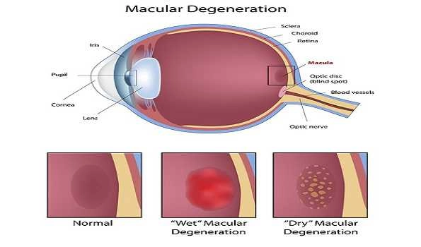 Age-related macular degeneration, a condition affecting older people