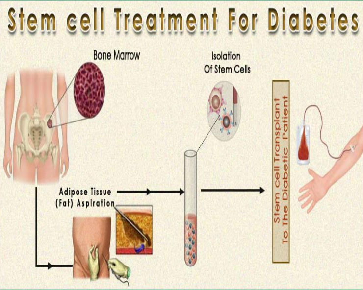Stem cell therapy can cure Diabetes