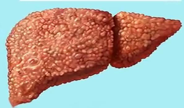 Cirrhosis of liver end stage of chronic liver disease