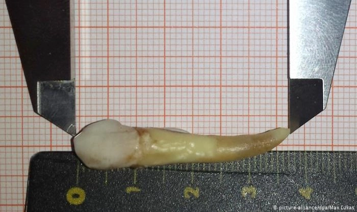 German dentist pulls world's longest known 37 mm tooth