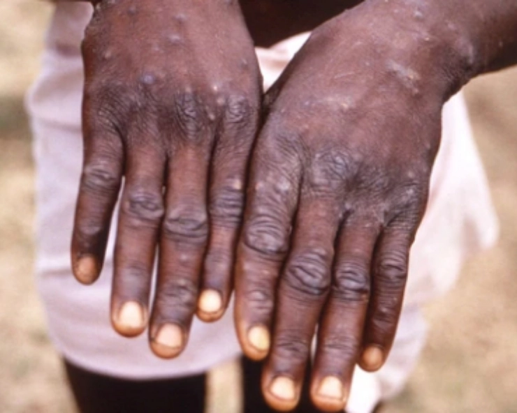 Don't panic when it comes to monkeypox — but do be cautious