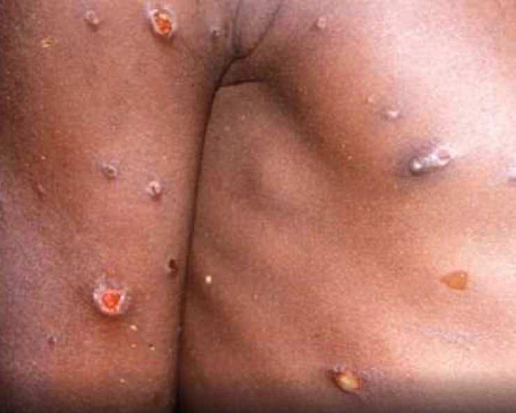 Here’s why WHO changing name of monkeypox