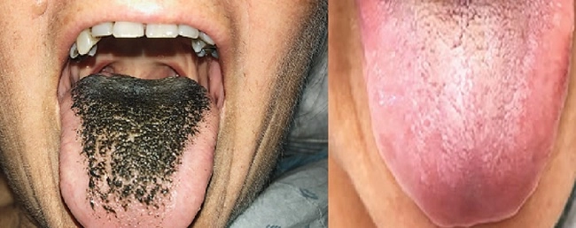 Black tongue काळी जीभ, गंभीर आजाराचे लक्षणं, कारणं आणि उपचाराबद्दल जाणून घ्या