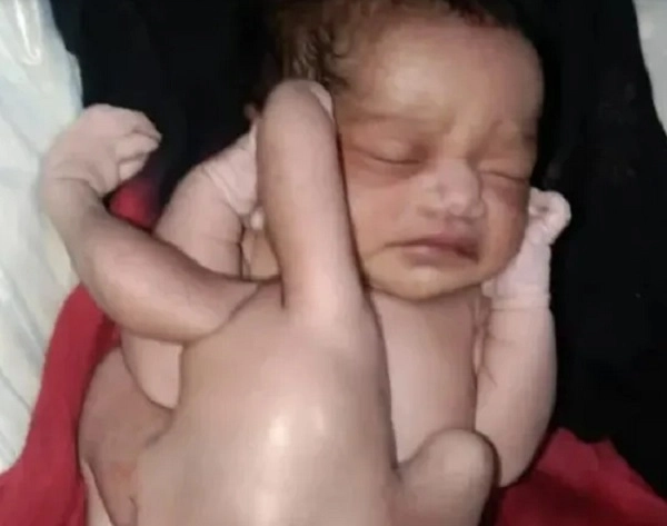 child born with 4 hands 4 legs