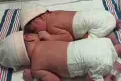नसबंदी के तीन साल बाद जुड़वा बच्चे जन्मे - Sterilization