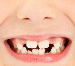 दूर रखें दांत की बीमारी - Tooth disease