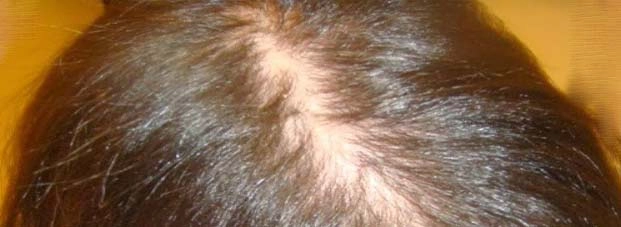 अथर्ववेद में है गंजेपन का सटीक इलाज | baldness treatment