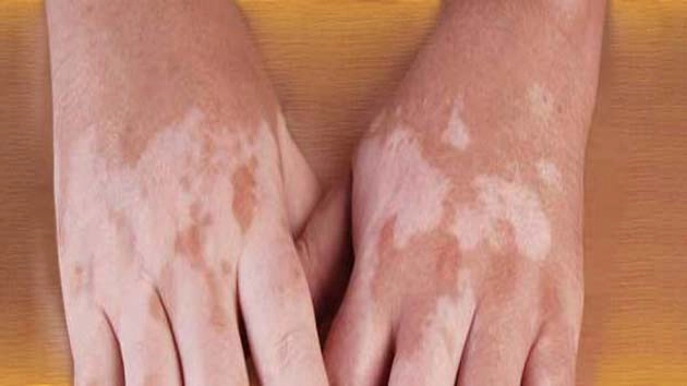 सफेद दाग मिटा सकते हैं, यह 7 तरीके - White Patches On Skin