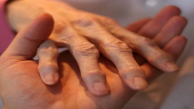 मंडरा रहा है यूर्मेटॉयड आॅॅर्थराइटिस का खतरा - Rheumatoid Arthritis
