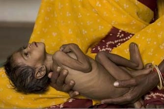 कुपोषण का विकास आखिर कब तक? - Malnutrition, malnourished children