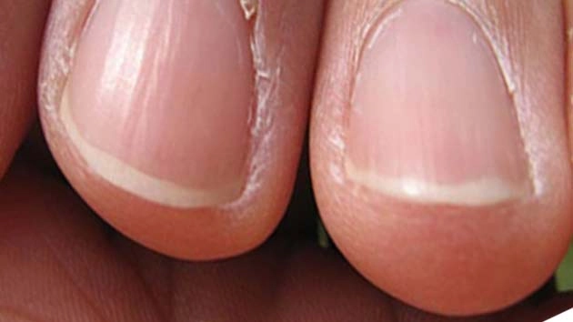नाखून कुछ बदले-बदले से लगें तो सावधान हो जाइए, कहीं Coronavirus की चपेट में तो नहीं - COVID nails: these changes to your fingernails may show you've had coronavirus
