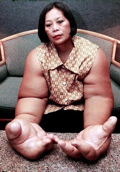मिलिए दैत्याकार हाथों वाली महिला से - Girl, giant hands, world